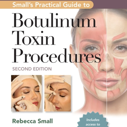 Small's Practical Guide to Botulinum Toxin Procedures