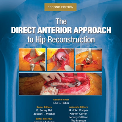 The Direct Anterior Approach to Hip Reconstruction