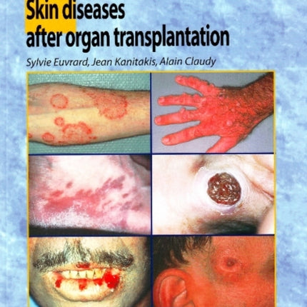 Skin Diseases After Organ Transplantation