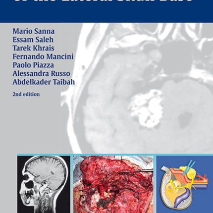 Atlas of Microsurgery of the Lateral Skull Base