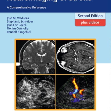 Neurosonology and Neuroimaging of Stroke: A Comprehensive Reference