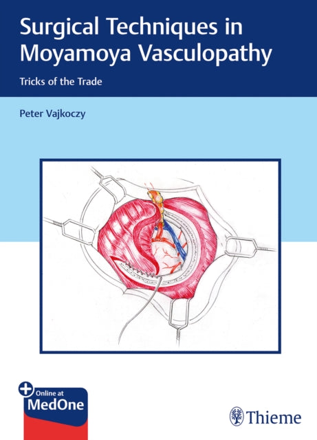 Surgical Techniques in Moyamoya Vasculopathy: Tricks of the Trade