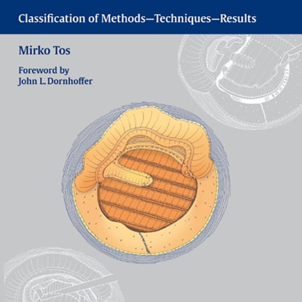 Cartilage Tympanoplasty: Classification of