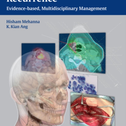 Head and Neck Cancer Recurrence: Evidence-based, Multidisciplinary Management