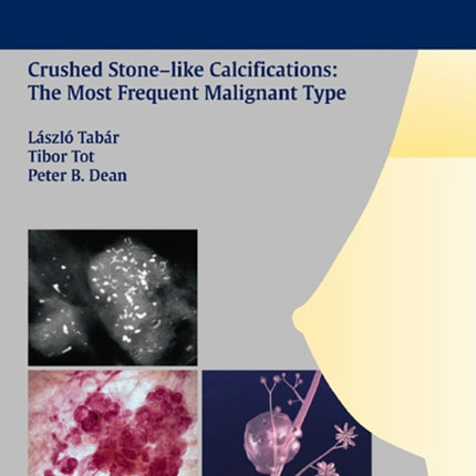 Breast Cancer: Early Detection with Mammography: Crushed Stone-like Calcifications: The Most Frequent Malignant Type