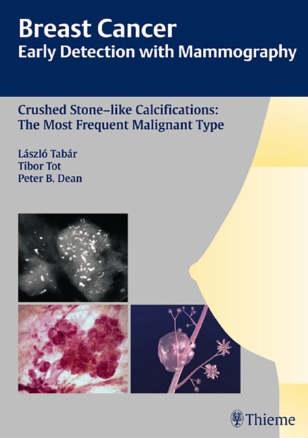 Breast Cancer: Early Detection with Mammography: Crushed Stone-like Calcifications: The Most Frequent Malignant Type