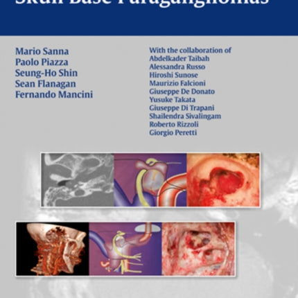 Microsurgery of Skull Base Paragangliomas