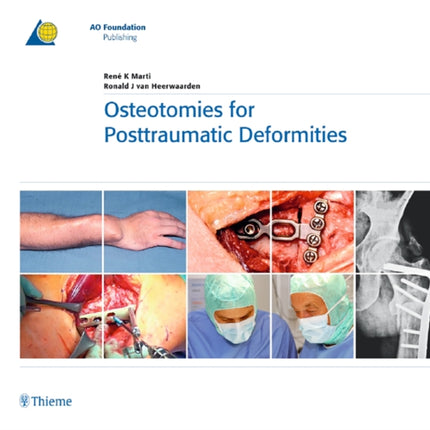 Osteotomies for Posttraumatic Deformities