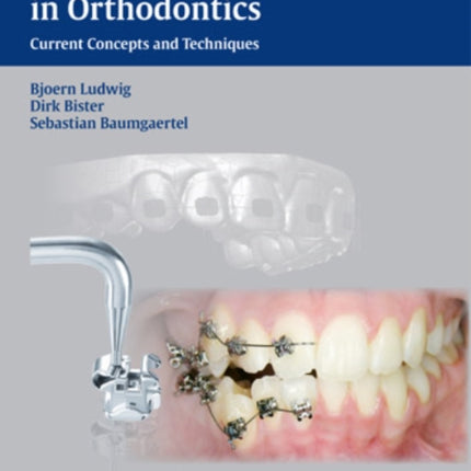 Self-Ligating Brackets in Orthodontics: Current Concepts and Techniques