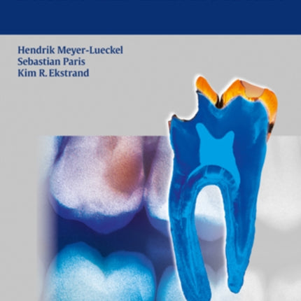 Caries Management - Science and Clinical Practice