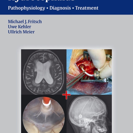 NPH - Normal Pressure Hydrocephalus: