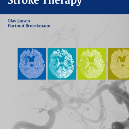 Interventional Stroke Therapy