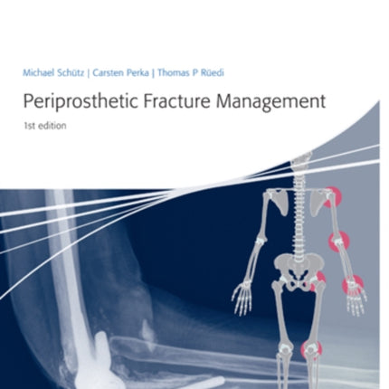 Periprosthetic Fracture Management