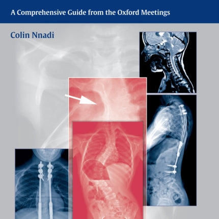 Early Onset Scoliosis: A Comprehensive Guide from the Oxford Meetings