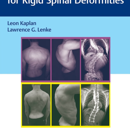 Corrective Osteotomies for Rigid Spinal Deformities