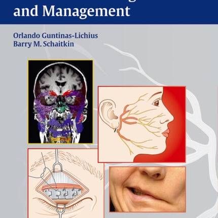 Facial Nerve Disorders and Diseases: Diagnosis and Management