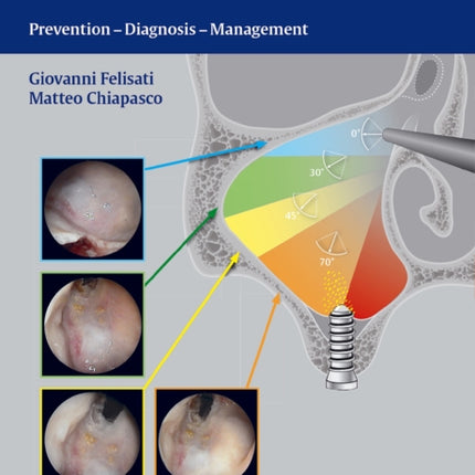 Sinonasal Complications of Dental Disease and Treatment: Prevention - Diagnosis - Management