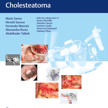 Microsurgical Management of Middle Ear and Petrous Bone Cholesteatoma