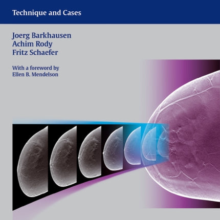 Digital Breast Tomosynthesis: Technique and Cases