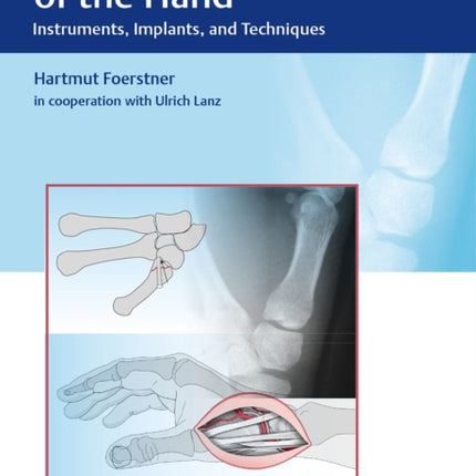 Osteosynthesis of the Hand: Instruments, Implants, and Techniques