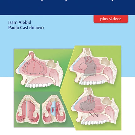 Nasoseptal Perforations: Endoscopic Repair Techniques