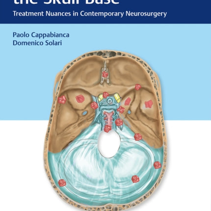 Meningiomas of the Skull Base