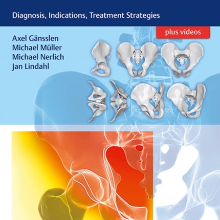 Acetabular Fractures: Diagnosis, Indications, Treatment Strategies