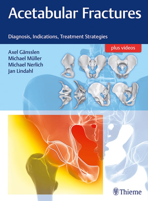 Acetabular Fractures: Diagnosis, Indications, Treatment Strategies