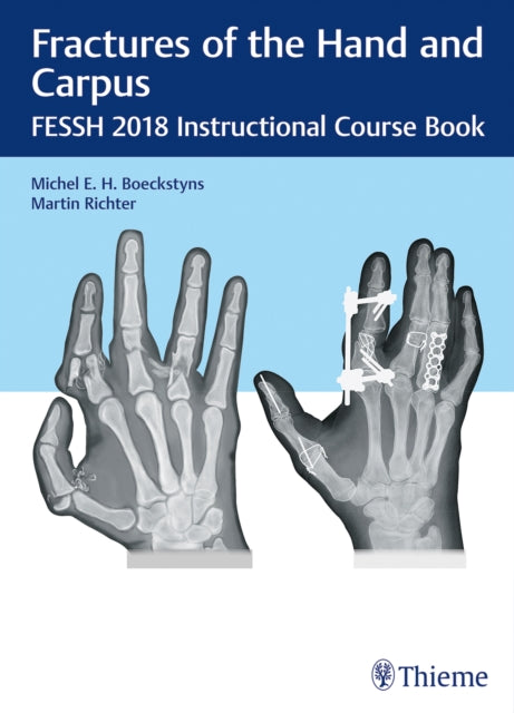 Fractures of the Hand and Carpus: FESSH 2018 Instructional Course Book