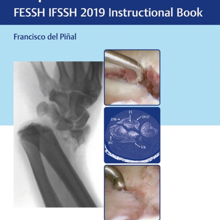 Distal Radius Fractures and Carpal Instabilities