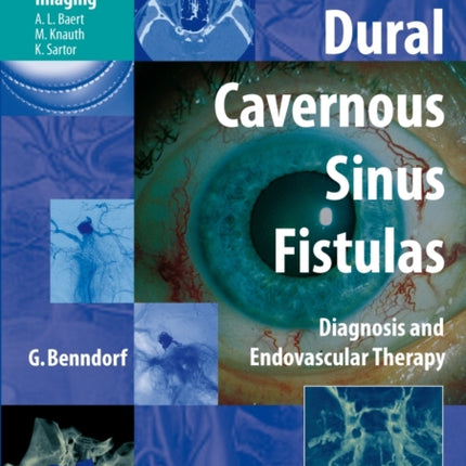 Dural Cavernous Sinus Fistulas: Diagnosis and