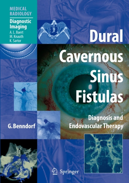 Dural Cavernous Sinus Fistulas: Diagnosis and