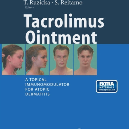 Tacrolimus Ointment: A Topical Immunomodulator for Atopic Dermatitis