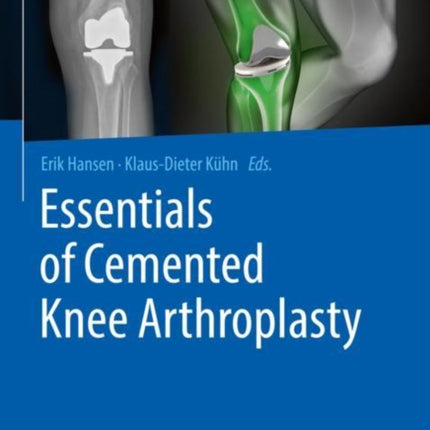 Essentials of Cemented Knee Arthroplasty