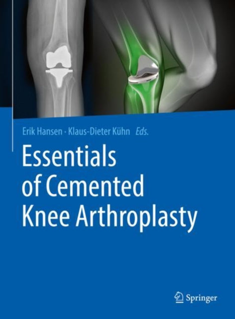 Essentials of Cemented Knee Arthroplasty