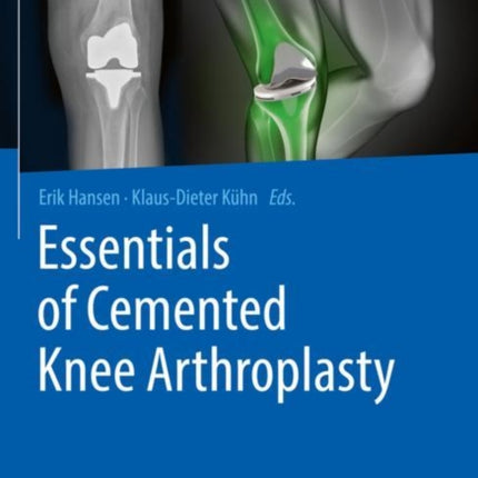 Essentials of Cemented Knee Arthroplasty