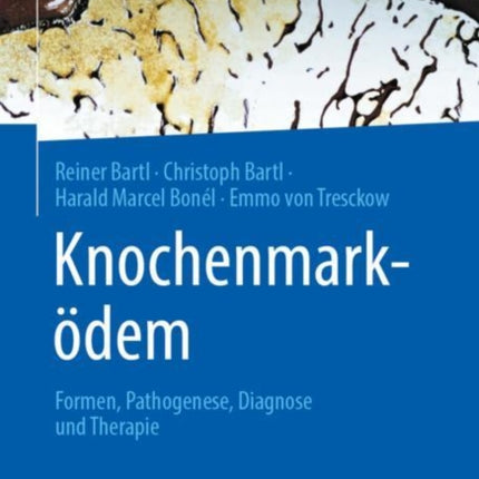 Knochenmarködem: Formen, Pathogenese, Diagnose und Therapie