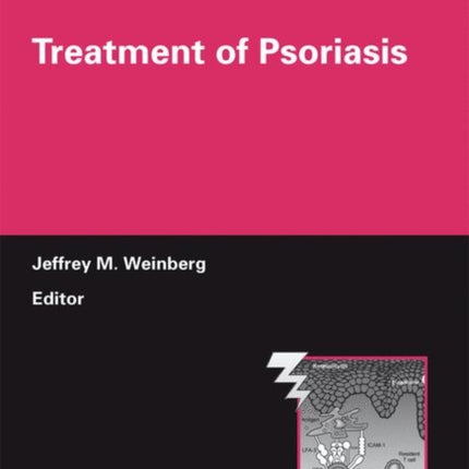 Treatment of Psoriasis