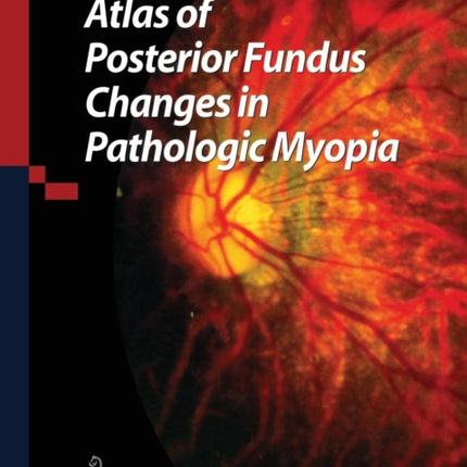 Atlas of Posterior Fundus Changes in Pathologic Myopia