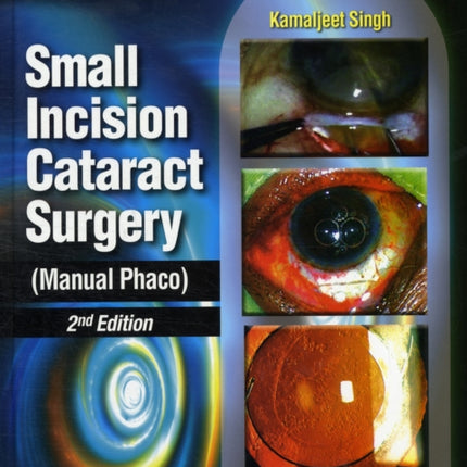 Small Incision Cataract Surgery (Manual Phaco)