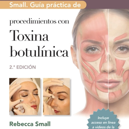 Small. Gu237a pr225ctica de procedimientos con toxina botul237nica