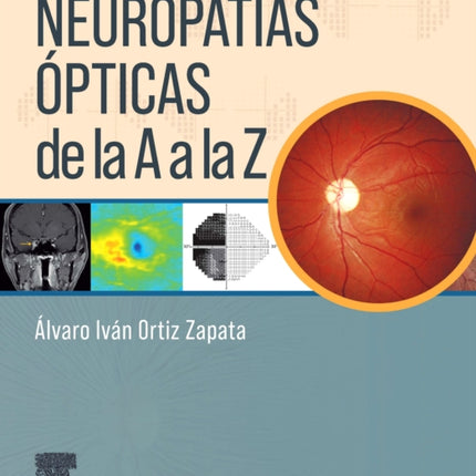 Neuropatías ópticas de la A a la Z