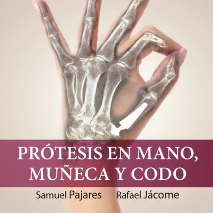 Prótesis en mano muñeca y codo