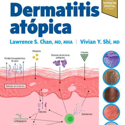 Dermatitis Atopica