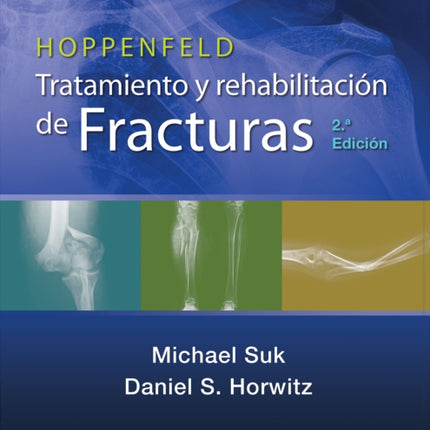 Hoppenfeld. Tratamiento y rehabilitación de fracturas