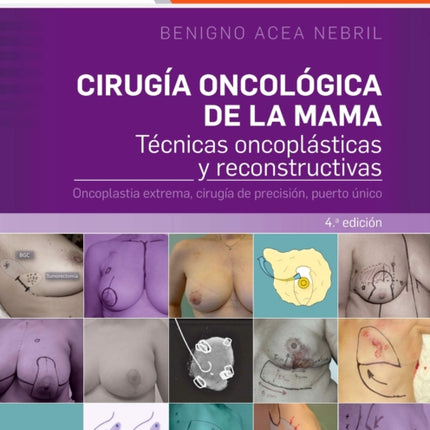 Cirugía oncológica de la mama