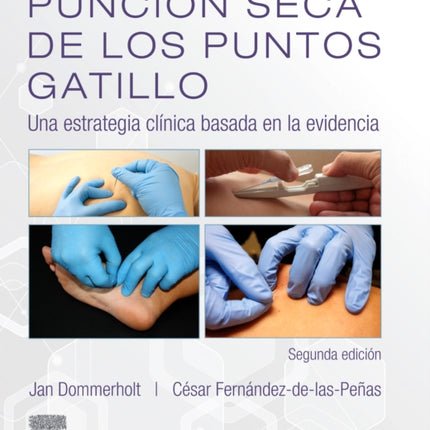 Punción seca de los puntos gatillo