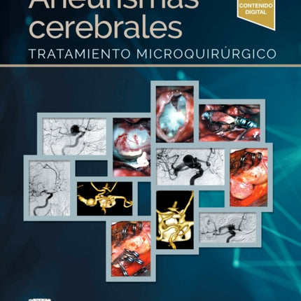 Aneurismas cerebrales Tratamiento microquirúrgico