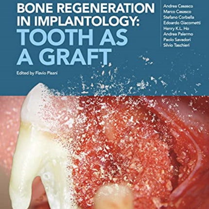 Bone regeneration in implantology  tooth as a graft