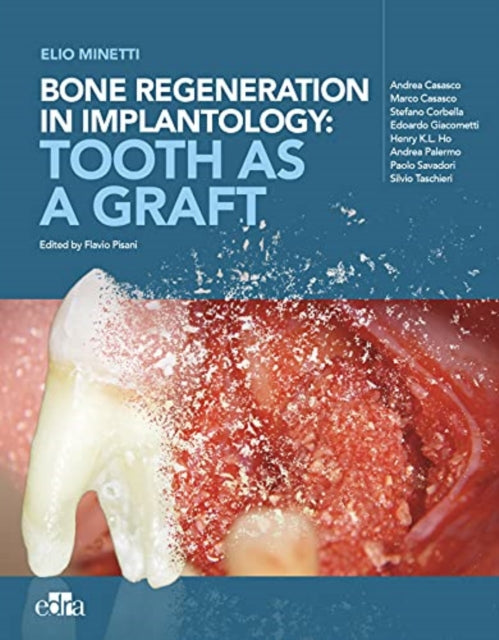 Bone regeneration in implantology  tooth as a graft